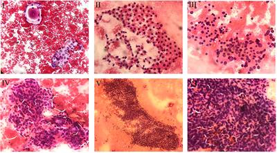 Clinico-cytopathological subcategorization in thyroid nodules of atypia of undetermined significance/follicular lesion of undetermined significance using the TIRADS and Bethesda classifications